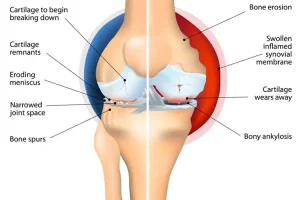 Osteoarthri