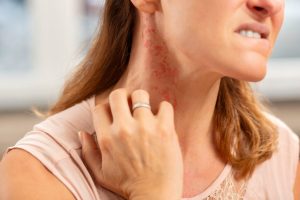 Home remedies to get rid of allergic itching