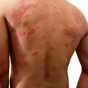 allergies