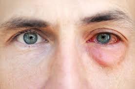 allergies