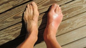 Uric Acid