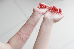 Home remedies to get rid of skin allergies